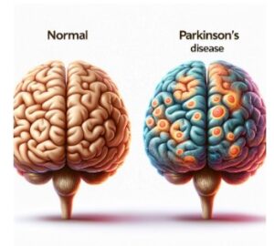 Healthy vs Parkinson's Affected Brain